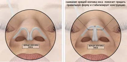 Ринопластика носа картоплею фото до і після (носа формі картоплі) Ринопластика носа картоплею фото до і після