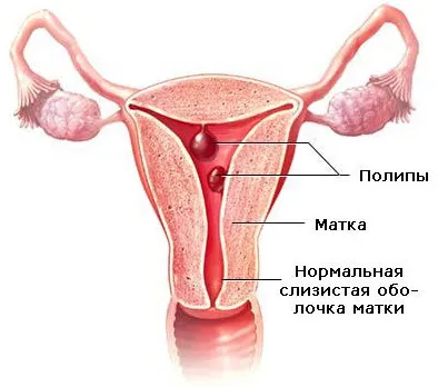 цервикални полипи, диагноза на симптомите и лечения