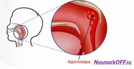 Носни полипи можем да предоставят лечение без операция у дома