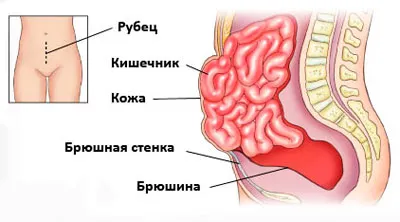 Следоперативна лечение на коремна херния без операция