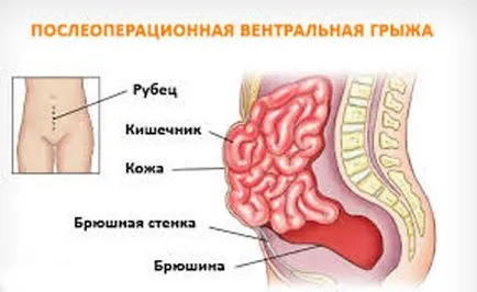 Следоперативна херния (вентралната) - корема, лечение, хирургия на стомаха,