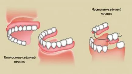 Правилната грижа за протези