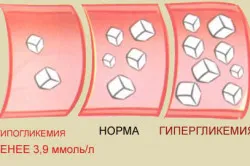 Rohamok hypoglykaemia cukorbetegség, fájdalom és görcsök