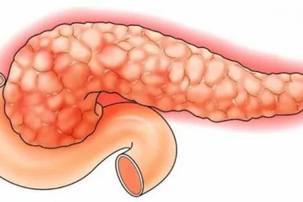Atac de simptome de pancreatită, ce să facă, tratament