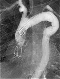 Аортната протеза - аортна аневризма хирургия