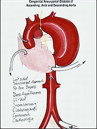 Аортната протеза - аортна аневризма хирургия