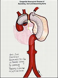 Aortic proteză - chirurgie anevrism aortic