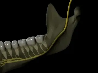 Vezetési érzéstelenítés az alsó állkapocs típusú, a technológia, jelzés, oslozhneniyanarkozis