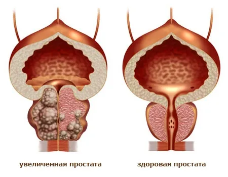 Dimensiuni de prostată cum de a reduce adenom de prostată mărită