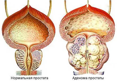 Méretek prosztata, hogyan lehet csökkenteni a megnagyobbodott prosztata adenoma