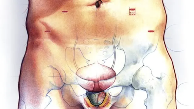 Dimensiuni de prostată cum de a reduce adenom de prostată mărită