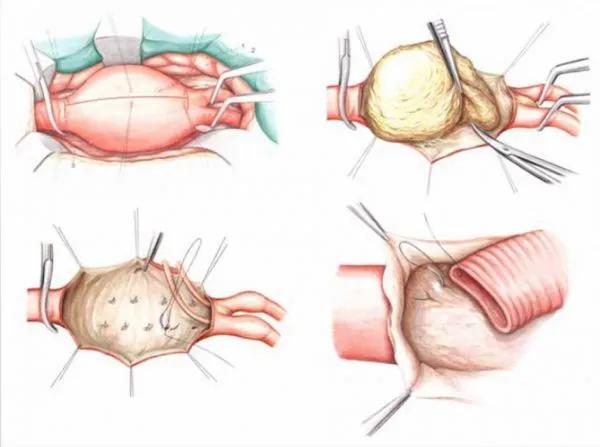 Rezecția abdominale aortice pregătire anevrism, intervenții chirurgicale, complicații