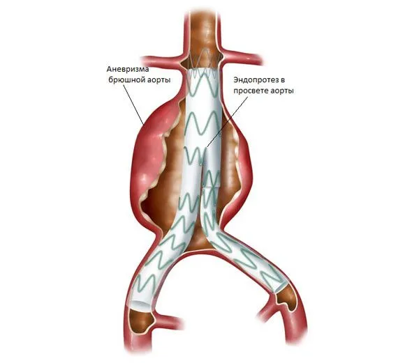 Rezecția abdominale aortice pregătire anevrism, intervenții chirurgicale, complicații