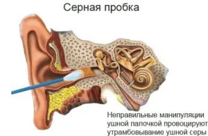 Ушна кал деца в ушите, които правят, симптоми