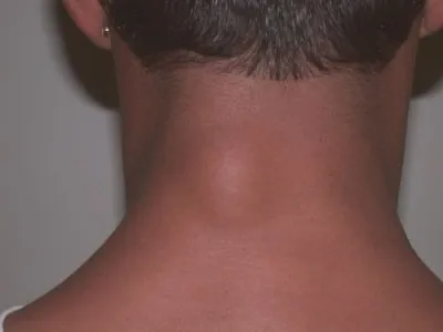 Бум на гърба на врата в областта на гръбначния стълб при възрастни може да се окаже за печата