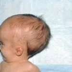 Обрив с менингит - тя изглежда като първите признаци при деца и възрастни, снимки