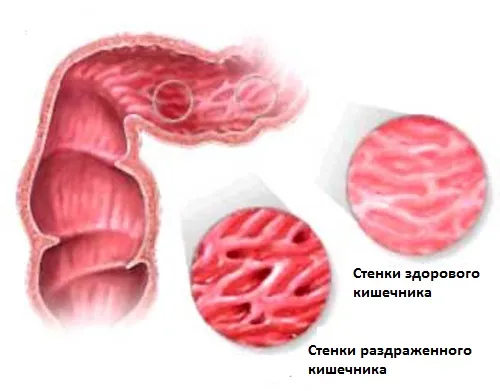 Sindromul de colon iritabil la un copil - cum să trateze