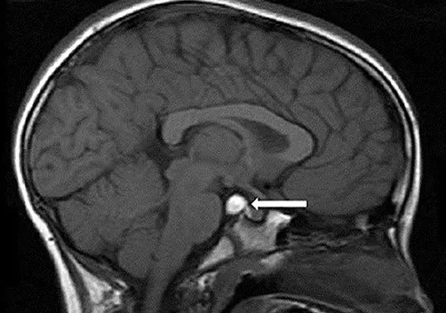 Simptomele și tratamentul de chisturi ale glandei pineale a creierului
