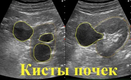 Solitary киста на причините на левия и десния бъбреците и лечение