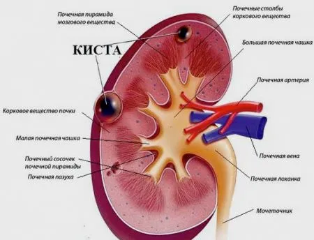 chist solitar din cauzele stânga și dreapta rinichi si tratament