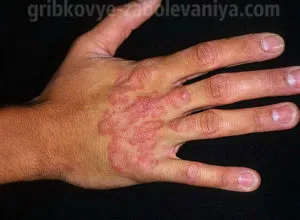 Rotrichosis okoz, tünetei, kezelés, vélemények, fotók