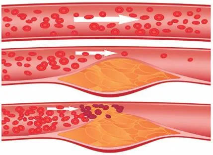 Összeszorítással atherosclerosis - Causes, tünetek és kezelés