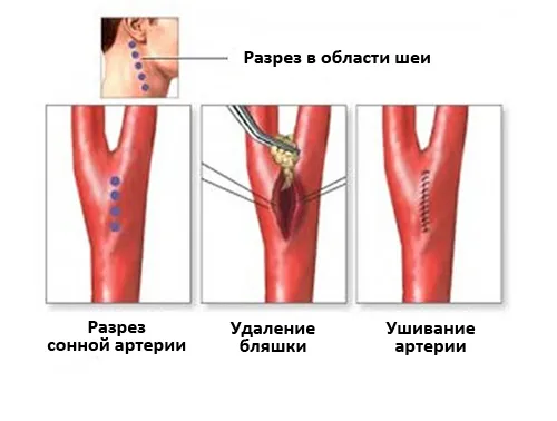 Каротидно стеноза и съвременни методи за лечение на 