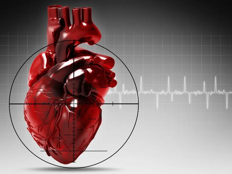 Stadiul infarctului miocardic și clasificarea tipurilor și formelor de infarct miocardic