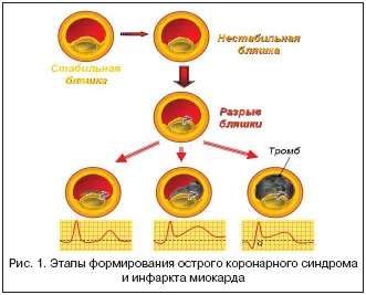 Tema tratamentului de lucru curs de complicații infarct miocardic