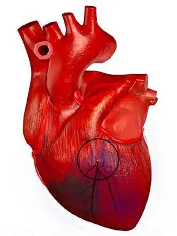 Темата на курсовата работа лечение на инфаркт на миокарда усложнения на