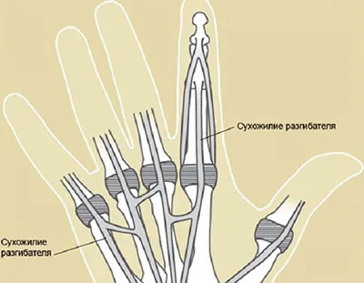 Тендинит на лечение на китката на ръката флексорният пръст