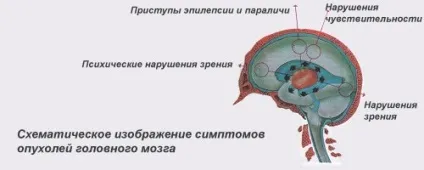 Саркома головного мозку симптоми і лікування (саркоми головного мозку) Саркома головного мозку симптоми і лікування
