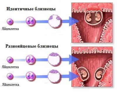 Tipuri de gemeni gemeni monochorionic