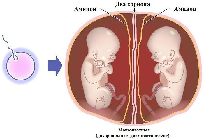 Видове близнаци monochorionic близнаци