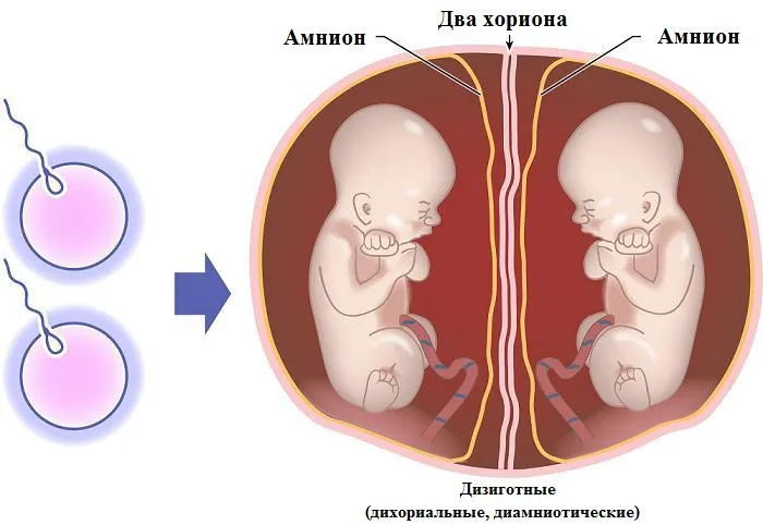 Видове близнаци monochorionic близнаци