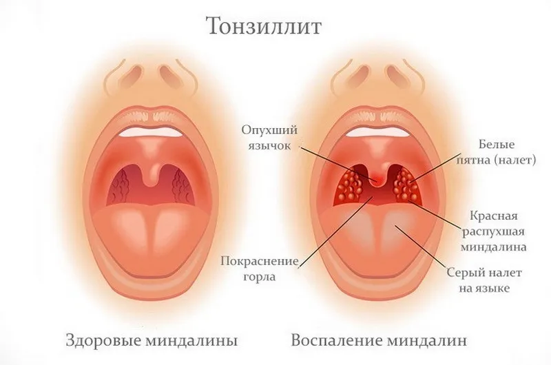 Тонзилит лечение по време на бременността, какво и как да се отнасяме последствията за детето