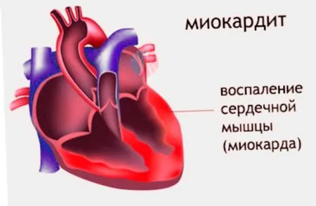 Тъпа болка в сърцето