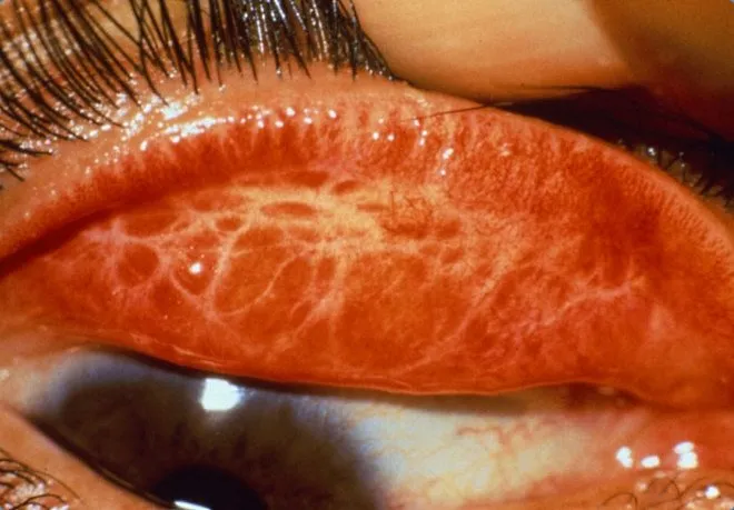 A trachoma egy szem - fotók, tünetei, kezelése és megelőzése