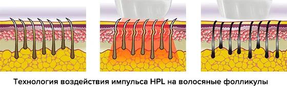 Îndepărtarea părului pe pielea sensibilă - alege mod eficient