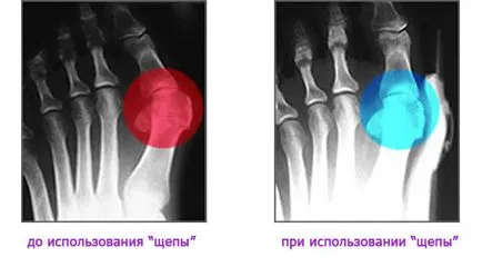 Valgus csuklós autóbusz hallufix