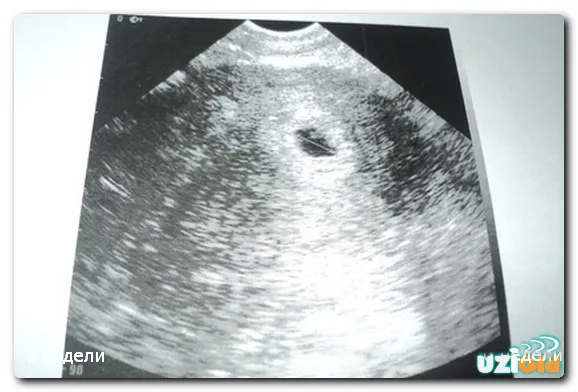 Uzi на 1, 2, 3 седмици от бременността; ще покаже дали ултразвук снимката на