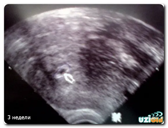 Uzi на 1, 2, 3 седмици от бременността; ще покаже дали ултразвук снимката на