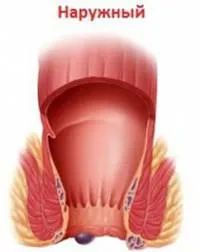 Видове хемороиди класификация, какви са сортовете, методи на лечение