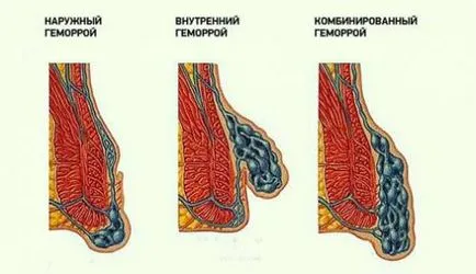 Видове хемороиди класификация, какви са сортовете, методи на лечение