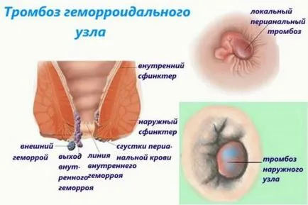 Видове хемороиди класификация, какви са сортовете, методи на лечение