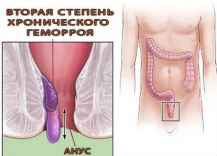 Tipuri de clasificare hemoroizi, care sunt soiurile, metodele de tratament