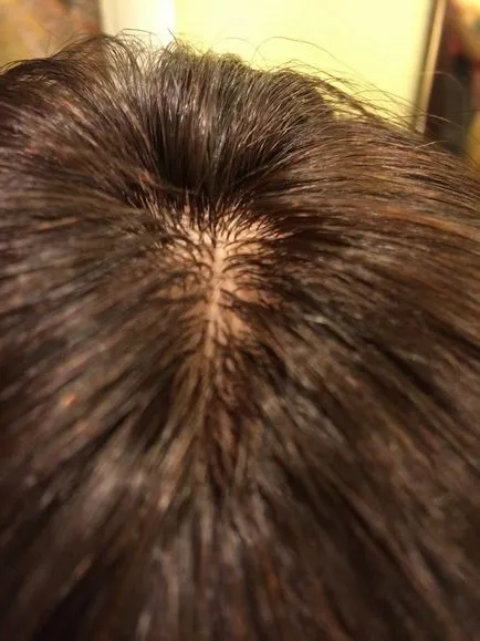 възстановяване на косата в центъра на косата подмяна гама