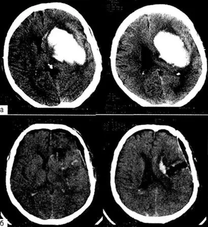 Tratamentul chirurgical al hematoame intracerebrale