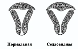 Сідлоподібна матка - чи можливо зачаття і вагітність (сідлоподібна матка - чи можливо зачаття і вагітність?) Сідлоподібна матка - чи можливо зачаття і вагітність