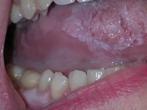 Заболявания на устата